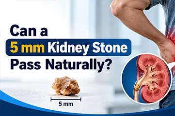 Can a 5 mm Kidney Stone Pass Naturally? Chances, Time & Treatment (2026)