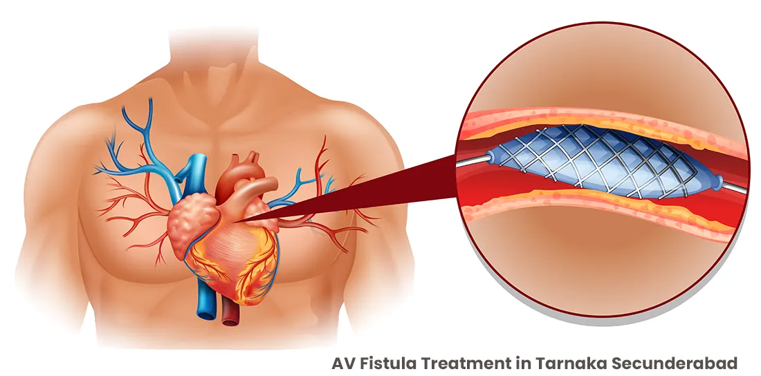 AV Fistula Treatment in Tarnaka Secunderabad