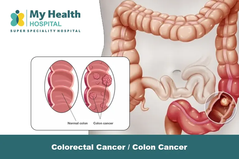 Colorectal and colon cancer treatment in Kukatpally