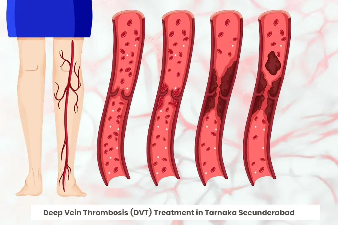 Deep Venous Thrombosis (DVT) Treatment in Tarnaka Secunderabad