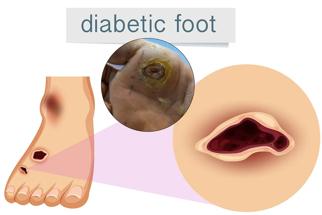 Diabetic Foot Ulcer Treatment in Tarnaka, Secunderabad