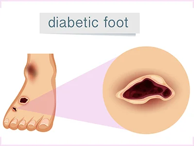 Diabetic Foot Ulcer Treatment in kukatpally