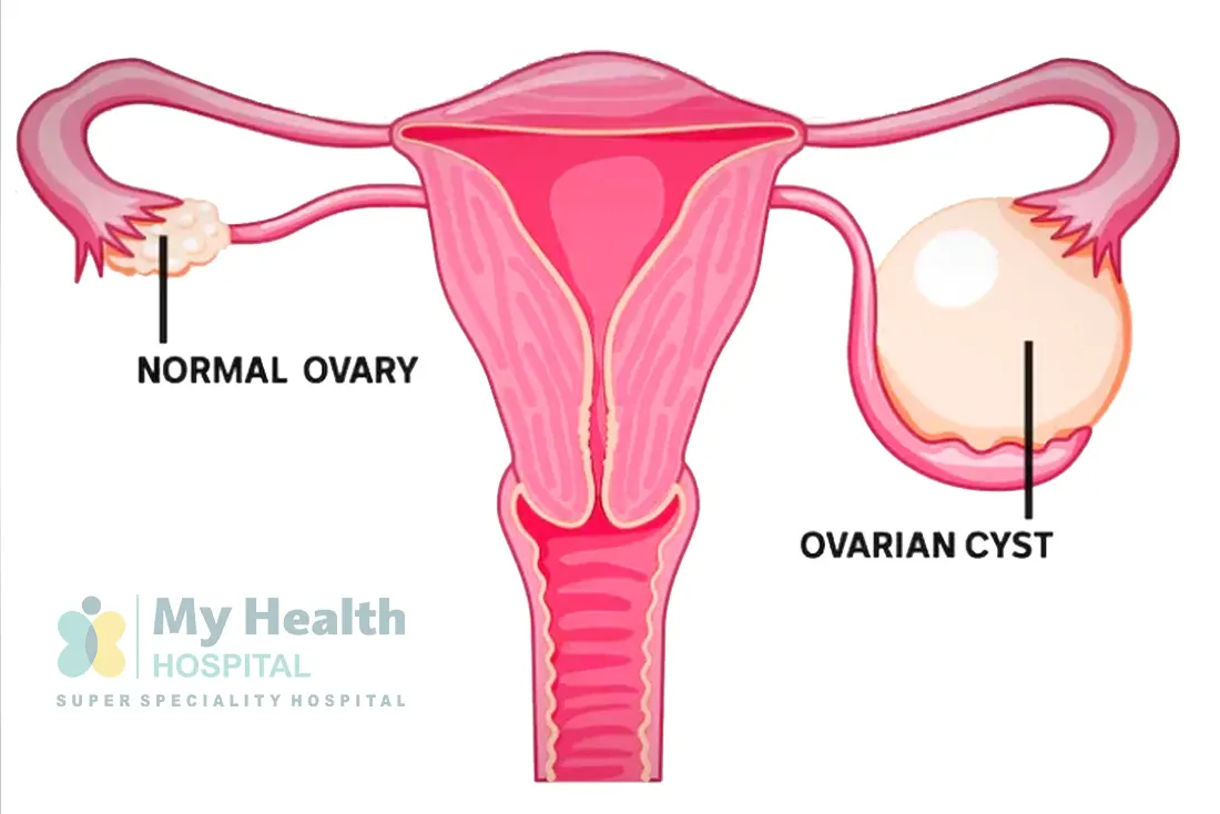 Ovarian Cyst Treatment in Tarnaka, Secunderabad