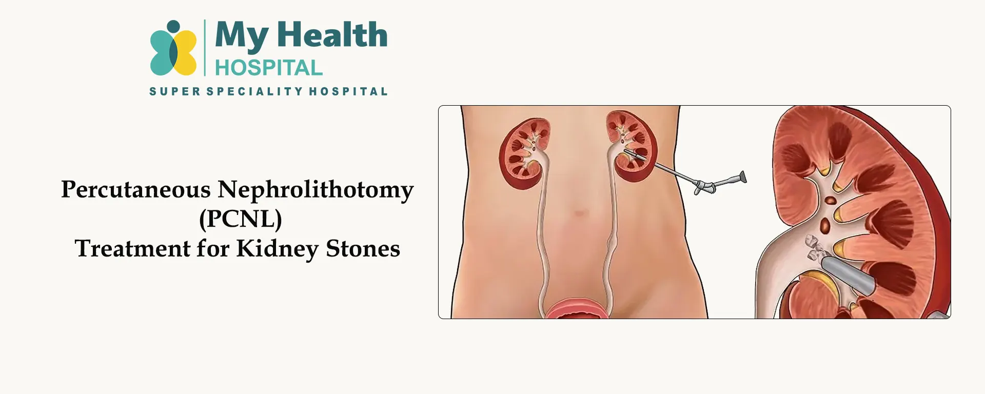 Percutaneous Nephrolithotomy (PCNL) Treatment for Kidney Stones