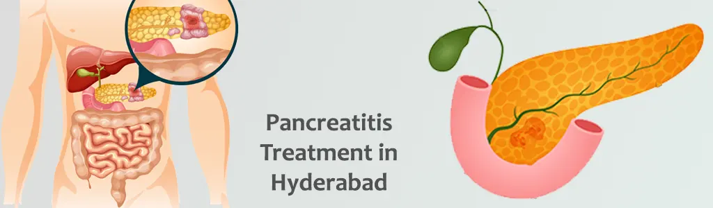 Pancreatitis-Treatment-Hyderabad