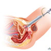 Stricture Urethra treatment in kukatpally