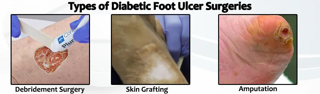 Types of Diabetic Foot Ulcer Surgeries