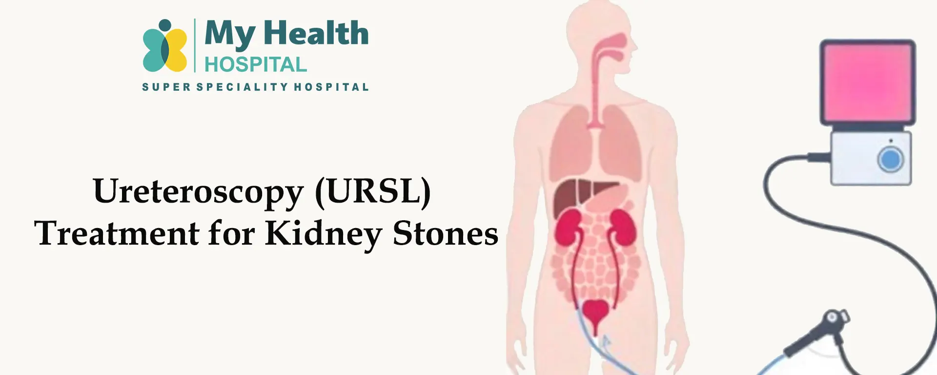 Ureteroscopy (URSL) Treatment for Kidney Stones