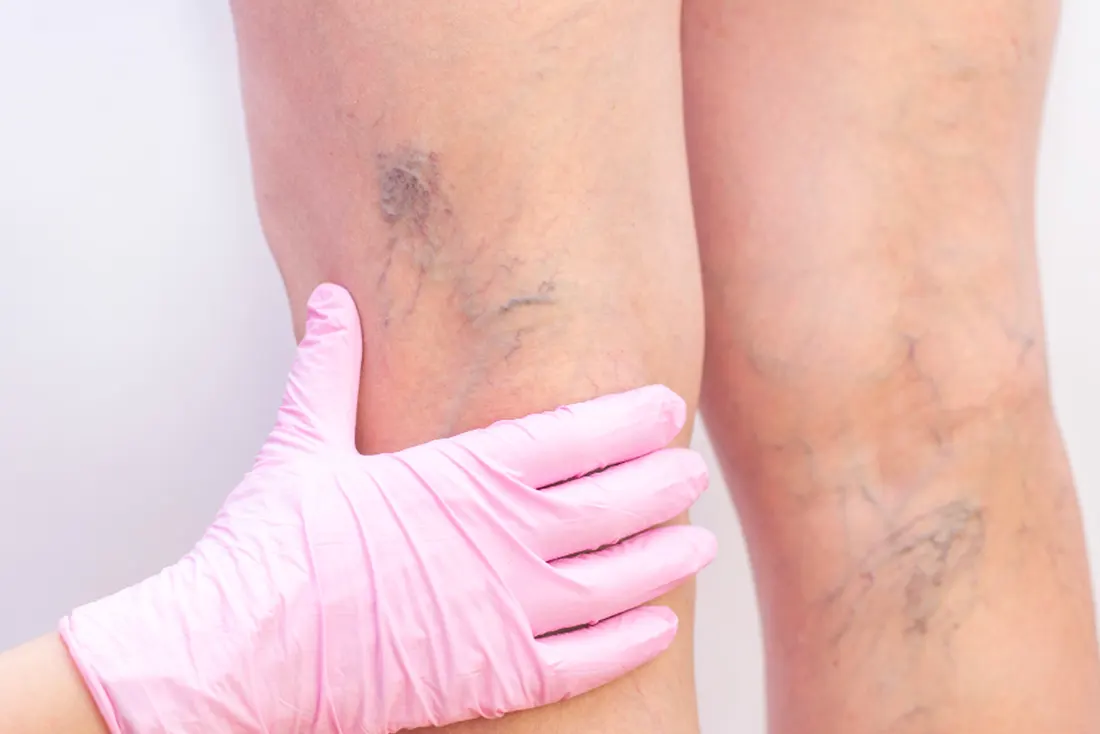 Varicose Veins Specialist in Secunderabad | Dr. Puneeth Joopalli