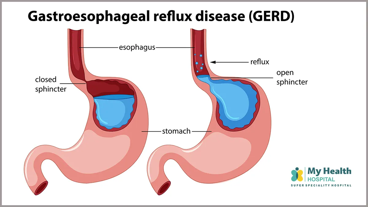 GERD Treatment in Hyderabad - Dr Krishna Chaitanya Vattem