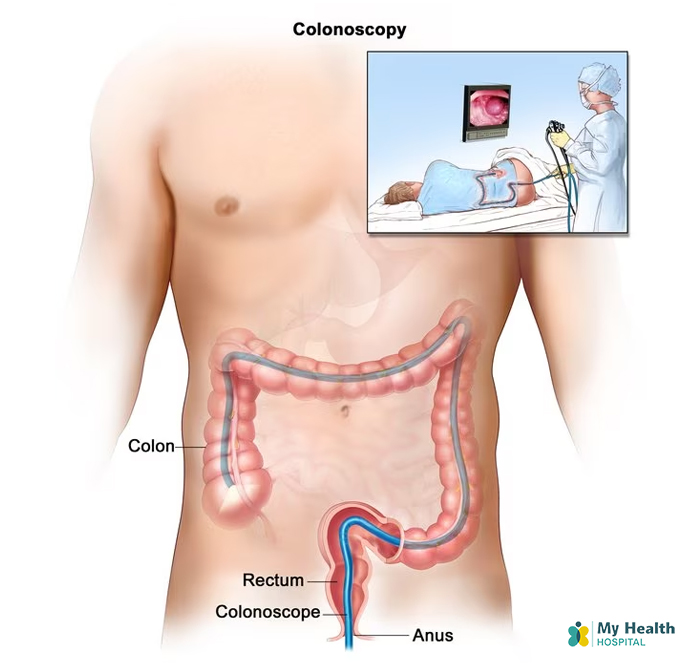 Colorectal cancer treatment kukatpally hyderabad