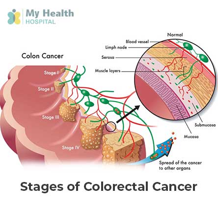 Stages of Colorectal Cancer