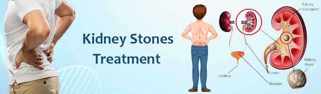 Expert Kidney Stones Doctor for Effective Treatment