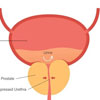 MaleInfertility/Varicocele Treatment in kukatpally