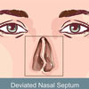 Deaviated Nasal Septum