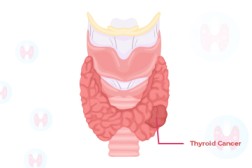 thyroid-cancer-symptoms-diagnosis-treatment-prognosis