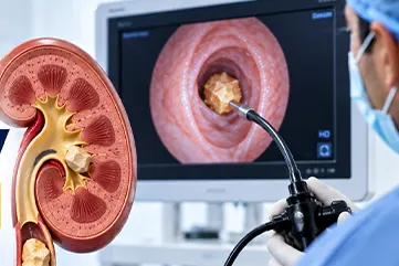 Ureteroscopy Cost in Hyderabad (2026): URS Kidney Stone Surgery Price