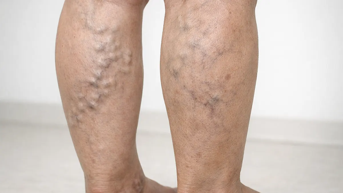 What Are Varicose Veins Explained