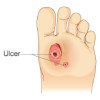 Diabetic-Foot-Ulcer