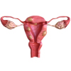 Uterine-Fibroid